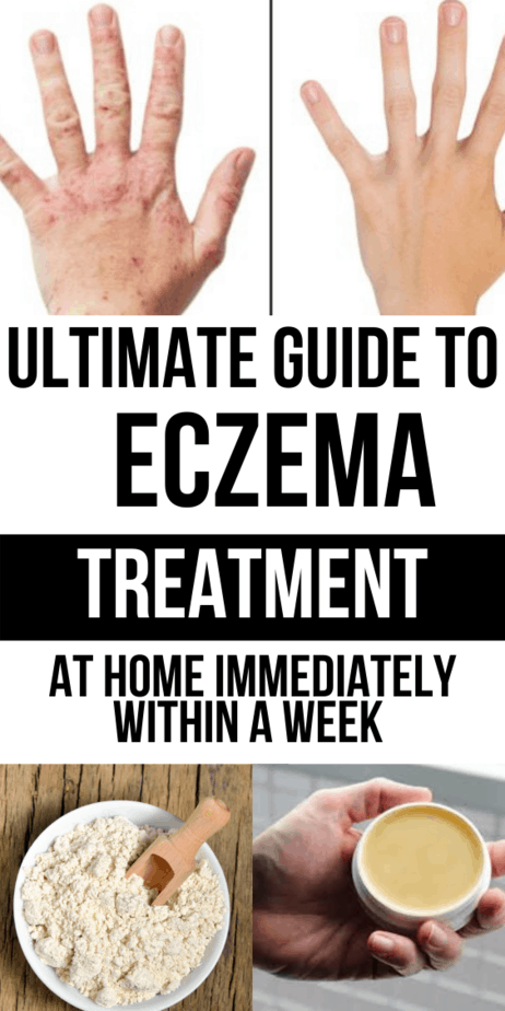 7 Ways to Deal With That Frustrating Hand Eczema For Your Awesome Look
