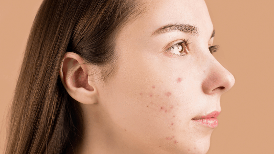 The Complete Guide To Treating Acne-Prone Skin