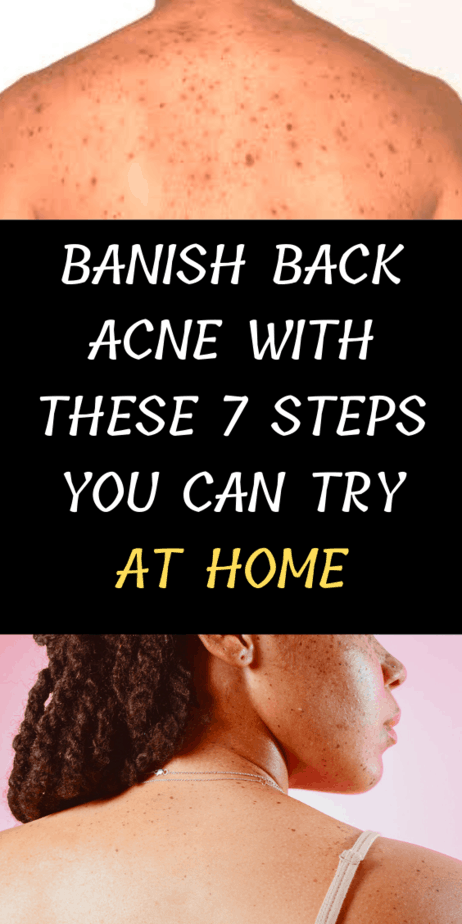 Banish Back Acne With These 7 Steps You Can Try At Home