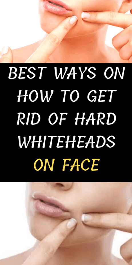 How To Get Rid Of Hard Whiteheads On Face