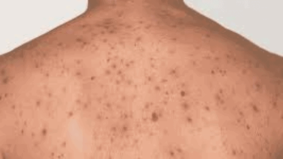 Banish Back Acne With These 7 Steps You Can Try At Home