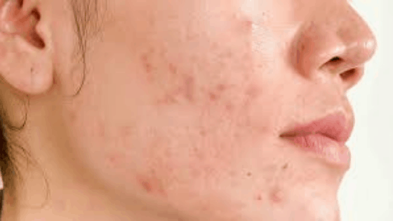 Dermatologists Say This Is How To Treat Hormonal Acne