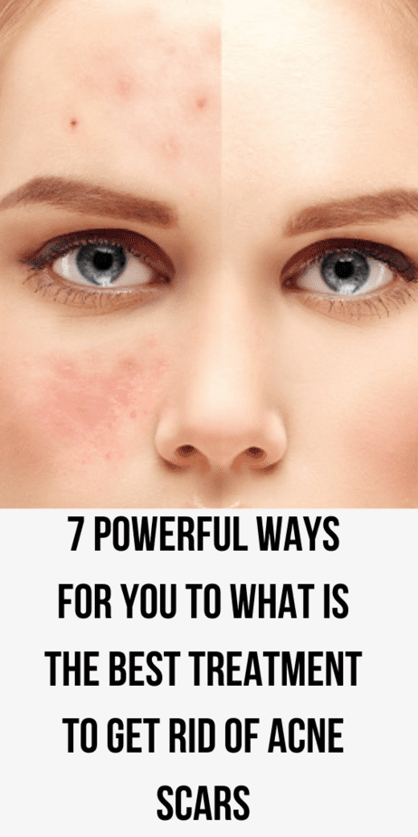 what-is-the-best-treatment-to-get-rid-of-acne-scars