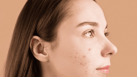 7 Powerful Ways For You To Know What Is The Best Treatment To Get Rid Of Acne Scars