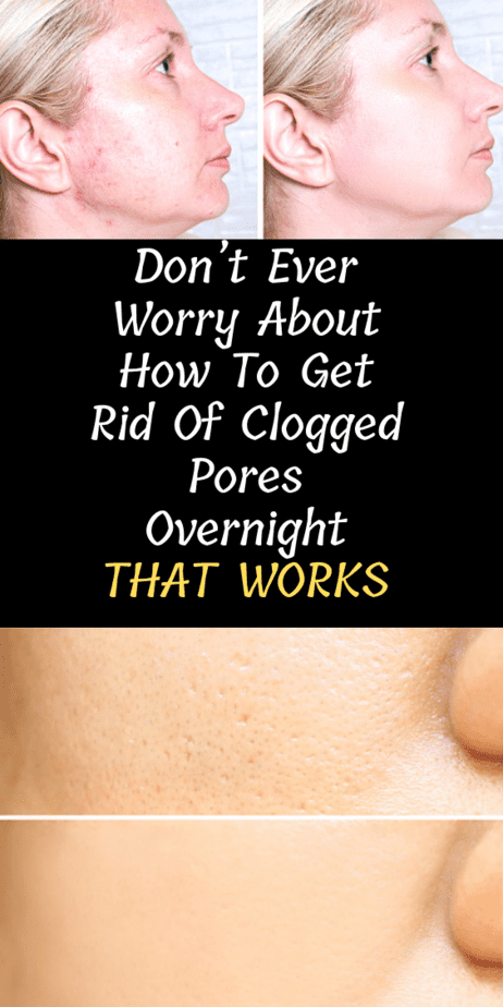 Don’t Ever Worry About How To Get Rid Of Clogged Pores Overnight