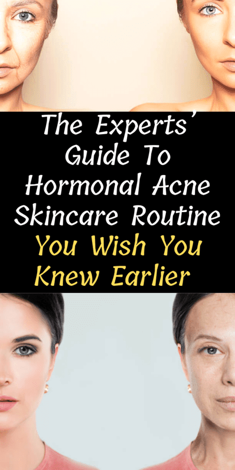 hormonal-acne-skincare-routine