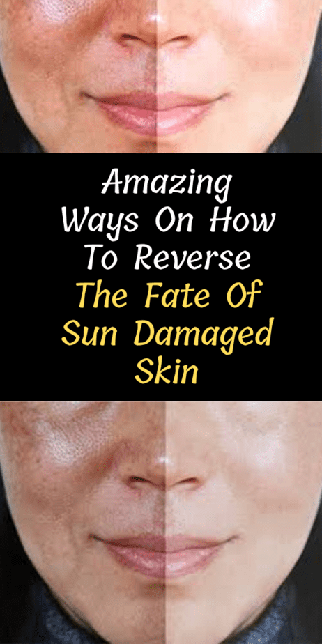 sun-damaged-skin