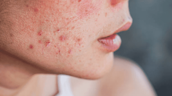 types-of-acne-treatment